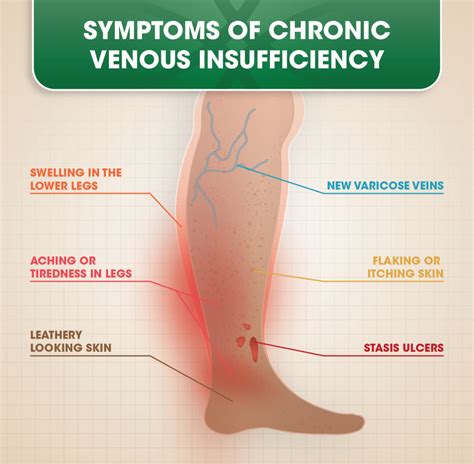 Chronic Venous Insufficiency Cvi Doc Vein Management