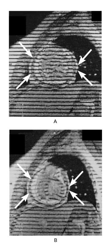 Diagnosis Of Constrictive Pericarditis By Tagged Cine Magnetic