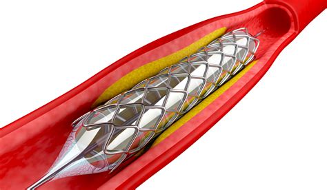 Coronary Angioplasty Centennial Heart Cardiovascular Consultants