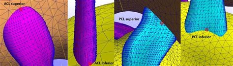 3d Assessment Of Graft Malposition After Acl Reconstruction Comparison