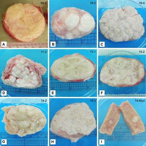 Frontiers Uterine Fibroids Causes Impact Treatment And Lens To