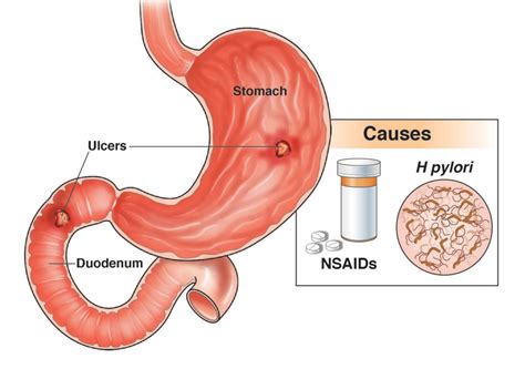 Stomach Peptic Ulcer Signs Symptoms Causes Treatment 42 Off