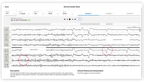 Ceribell Eeg Portal V Update