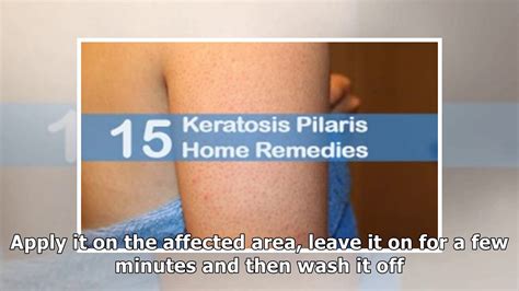 Home Remedies For Keratosis Pilaris Bumps On The Skin Youtube