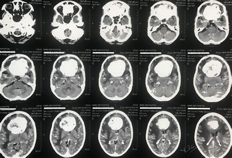 IntraCranial Meningioma. | Prof. Dr. Rajiv Jha