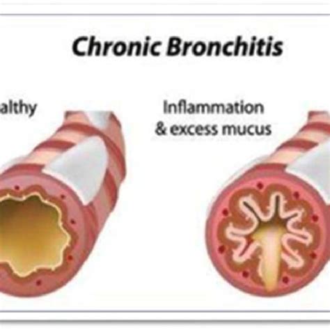 The healthy and damaged airways.[6] | Download Scientific Diagram