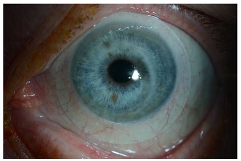 The Efficacy And Patient Satisfaction With A Mini Scleral Lens After