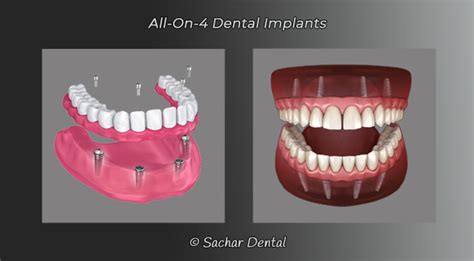 All On 4 Dental Implants NYC