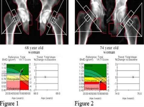 Bone Mineral Density Bmd Test