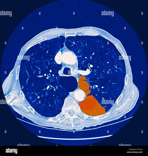 Ct of chest fotografías e imágenes de alta resolución Alamy