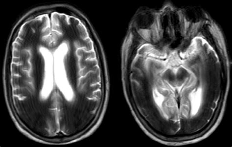 Magnetic Resonance Imaging T1 Noncontrast Sequence 5 Hours After