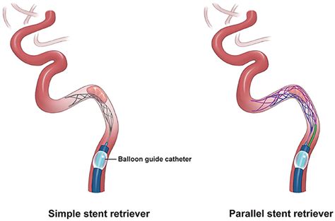 Frontiers Parallel Stent Retriever Mechanical Thrombectomy Of An