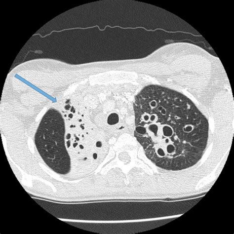 Radiology Bronchiectasis