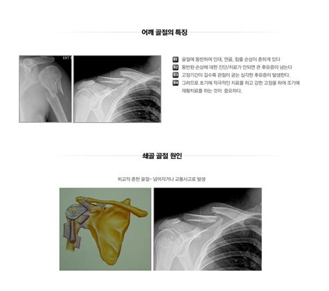 마디사랑병원 질환별 소개 어깨 어깨 관절의 외상