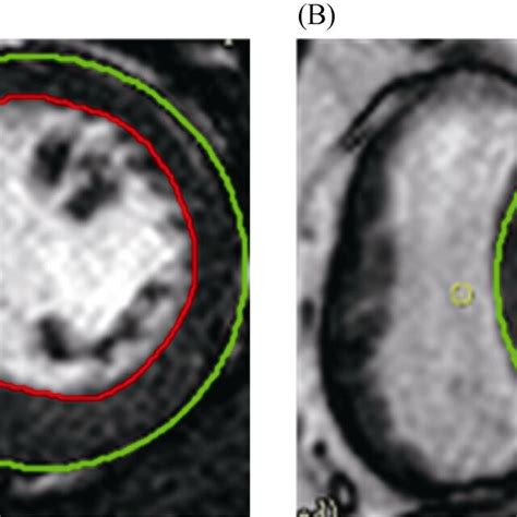 Cine Still Frame Images A Left Ventricular End Diastolic Volume