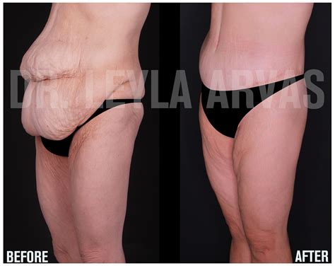 Get A Flat And Smooth Stomach With Tummy Tuck “abdominoplasty” By Op