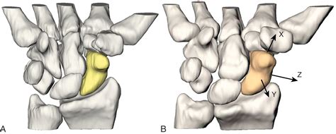 Fractures Of The Carpal Bones Clinical Tree