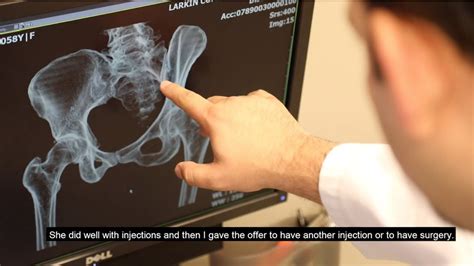 Sacroiliac Joint Fusion With The Ifuse Implant System Dr Valerio