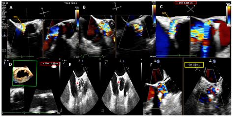 Baseline 2d 3d Transesophageal Echocardiogram Tee Color Doppler