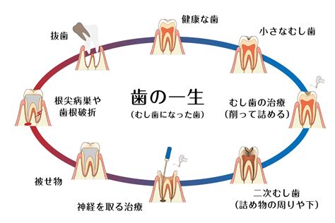 むし歯の治療 愛媛県松山市の歯医者『宮崎デンタルオフィス』｜歯科医院公式サイト