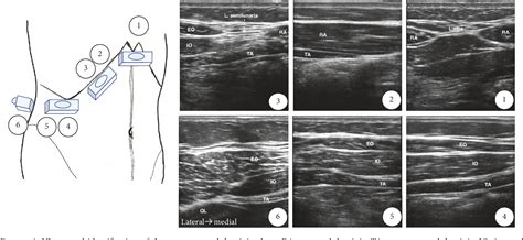 Figure 4 From Transversus Abdominis Plane Block An Updated Review Of