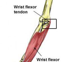 Elbow Avulsion Fracture | Symptoms & Treatment