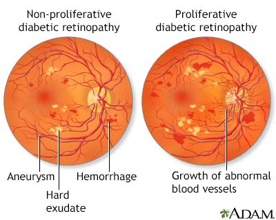 Diabetic Retinopathy Symptoms, Doctors, Treatments, Advances & More | MediFind