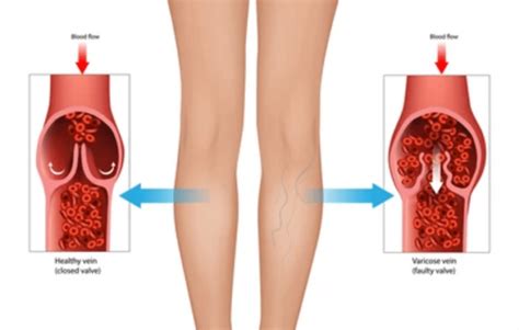 Chronic Venous Insufficiency Vs Lymphedema 5 Differences