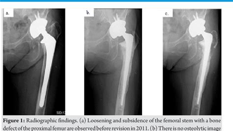 Figure 1 From Progressive Osteolysis With Hematoma Following Revision Total Hip Arthroplasty