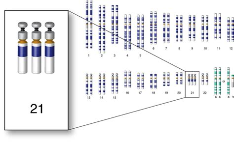 Down syndrome: MedlinePlus Genetics