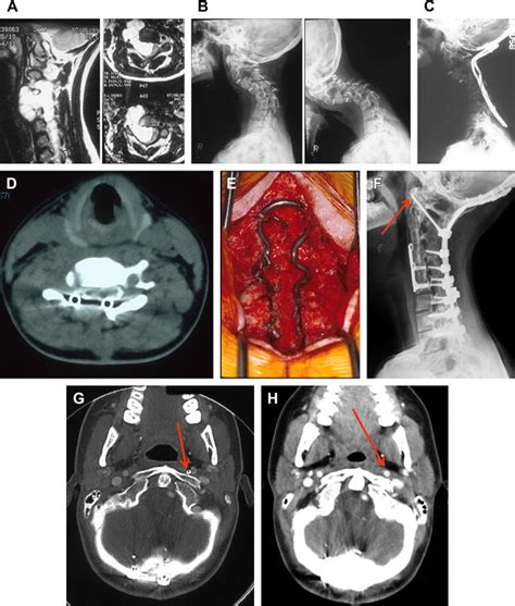 Surgical Management of Complex Spinal Deformity | Musculoskeletal Key