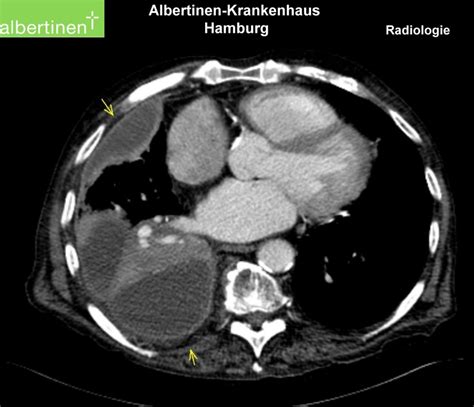 Ct Scan Of The Thorax Empyema Doccheck