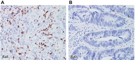 Immunostaining Of Cd8 Tils In Biopsy Samples Before Crt Showed A High