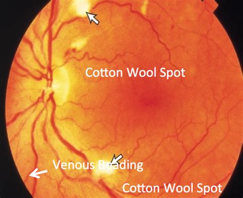 Cotton Wool Spots Vs Hard Exudates