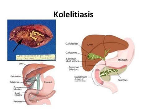 Askep Kolelitis