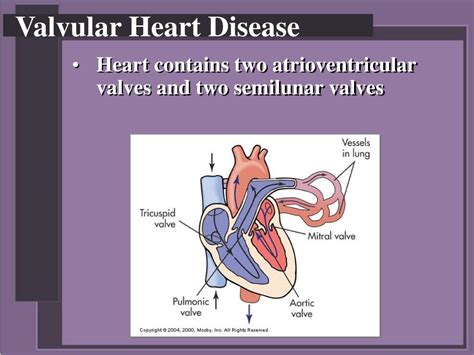 Ppt Inflammatory And Valvular Heart Diseases Powerpoint Presentation