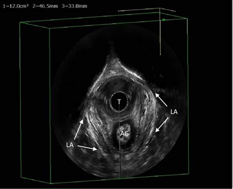 Three Dimensional Transvaginal Ultrasound Image Obtained With A