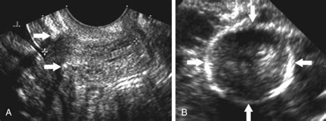 Ultrasound Evaluation Of The Gravid Cervix Radiology Key