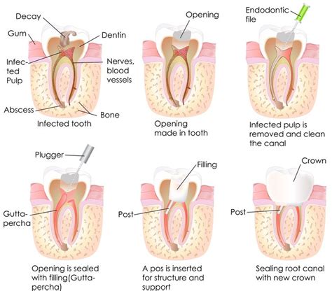 Root Canal Treatment Endodontic Treatment Explained News Dentagama