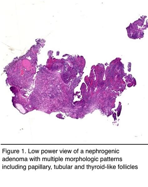 Pathology Outlines Nephrogenic Metaplasia Adenoma