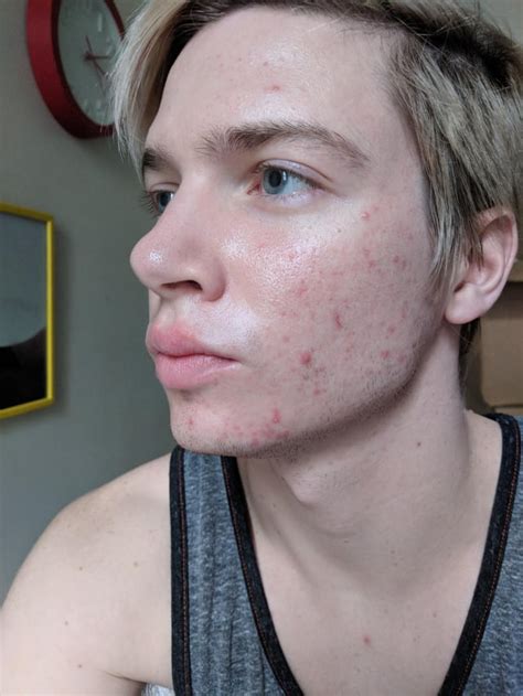 [routine Help] Male Adult Acne Post Accutane R Skincareaddiction