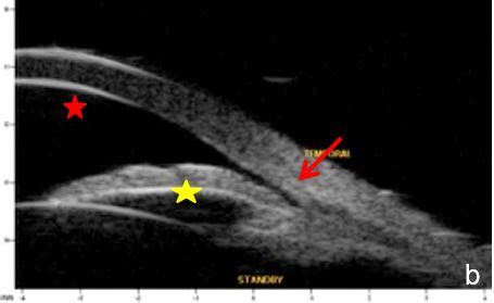 The Role of Anterior Segment Imaging in I. Glaucoma Diagnosis ...