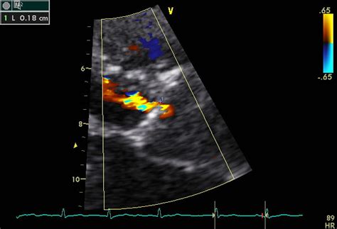 echotalk blog agora  echotalkblogcom salvem  vena contracta de