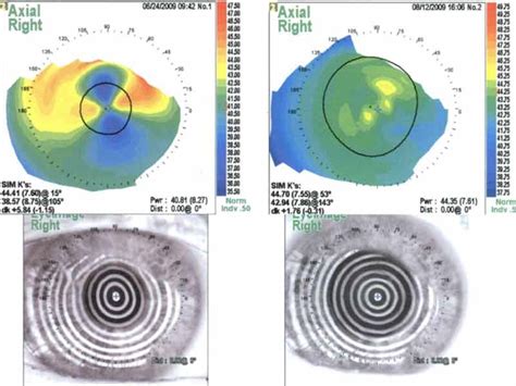 Salzmann's Nodular Corneal Degeneration: The University of Iowa ...