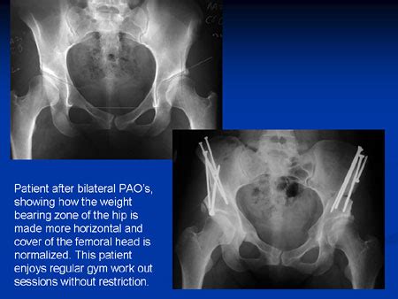 Hip Dysplasia - Hip Joint Surgery