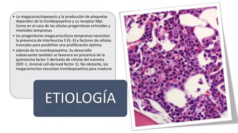 Enfermedades Mieloproliferativas Pptx