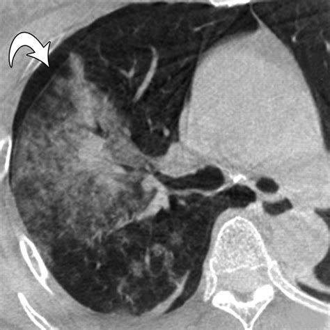 C Arm Cone Beam Ct Guided Percutaneous Transthoracic Needle Biopsy Of