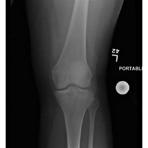 MRI of left knee showing popliteofibular ligament tear and edema in... | Download Scientific Diagram