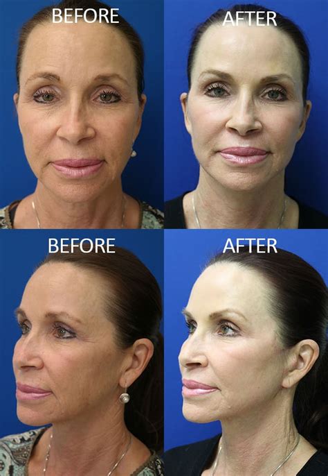 Co Laser Skin Resurfacing Before After Photo Gallery Nashville Tn