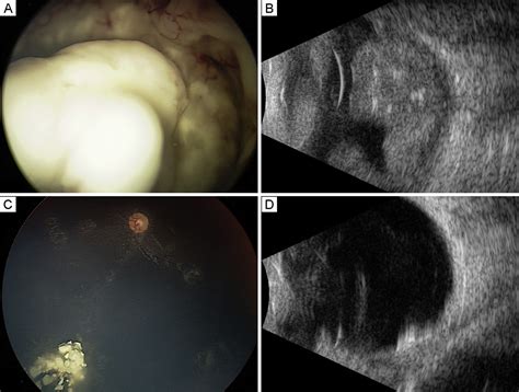 Intra Arterial Chemotherapy For Retinoblastoma In 341 Consecutive Eyes 1292 Infusions